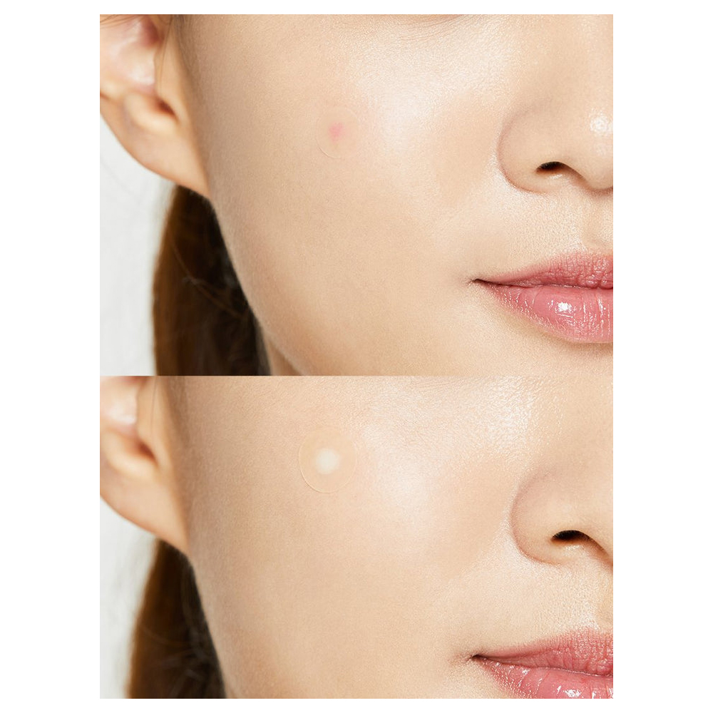 Cosrx Acne Pimple Master Patch - 24 Pimple Treatment Patch - Image 2